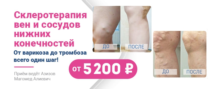 Склеротерапия по специальной цене: от 5 200р.